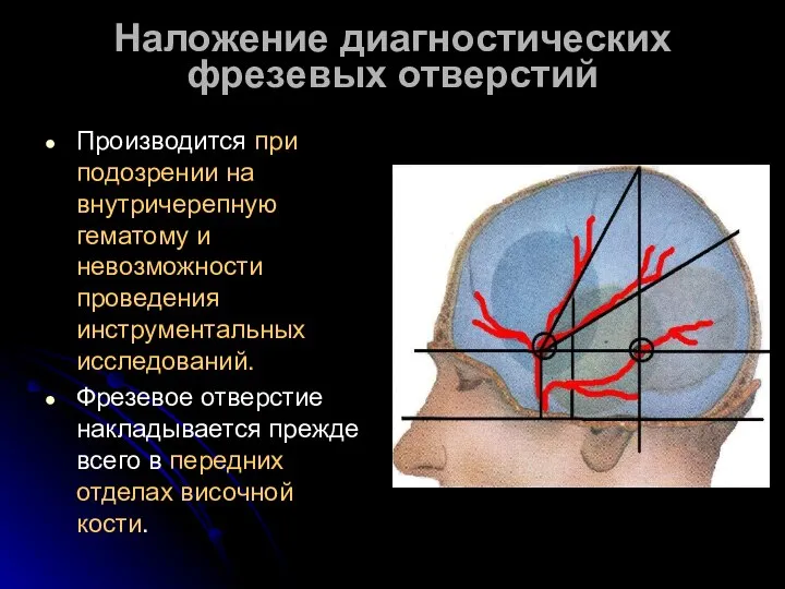 Наложение диагностических фрезевых отверстий Производится при подозрении на внутричерепную гематому и