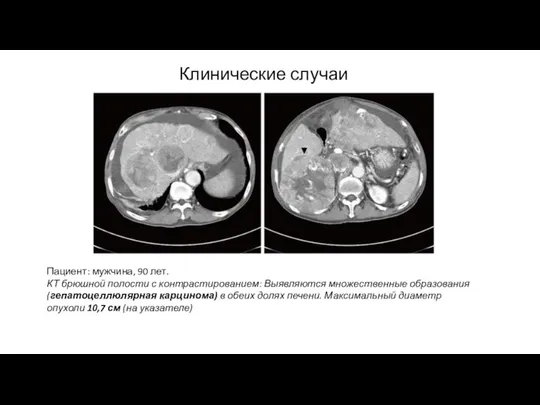 Клинические случаи Пациент: мужчина, 90 лет. КТ брюшной полости с контрастированием: