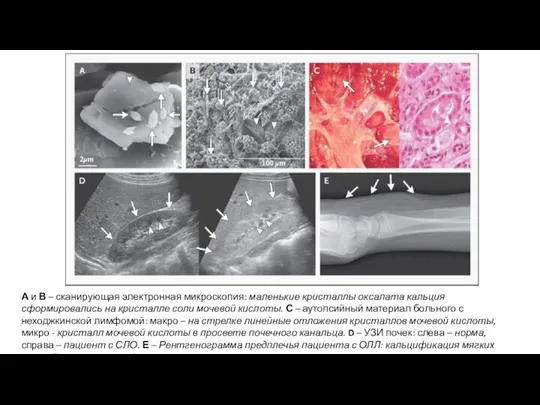 А и В – сканирующая электронная микроскопия: маленькие кристаллы оксалата кальция