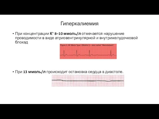 Гиперкалиемия При концентрации К+ 8–10 ммоль/л отмечается нарушение проводимости в виде