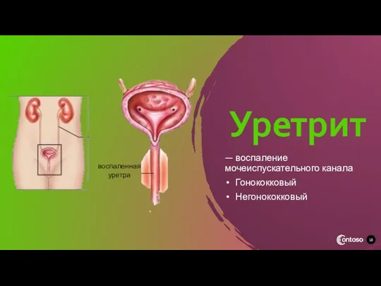 Уретрит — воспаление мочеиспускательного канала Гонококковый Негонококковый воспаленная уретра