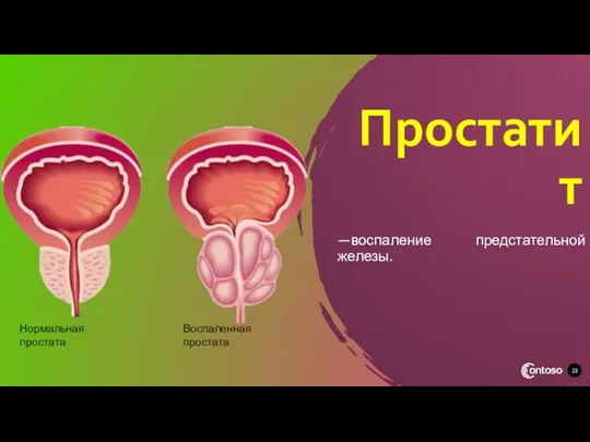 Простатит —воспаление предстательной железы. Нормальная простата Воспаленная простата