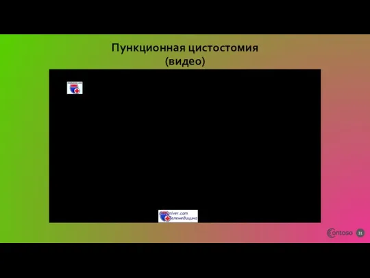 Пункционная цистостомия (видео)