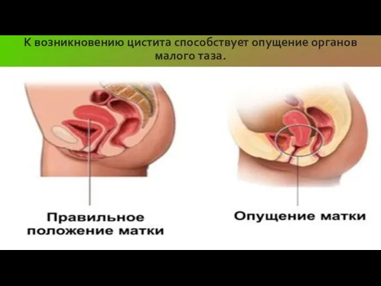 К возникновению цистита способствует опущение органов малого таза.