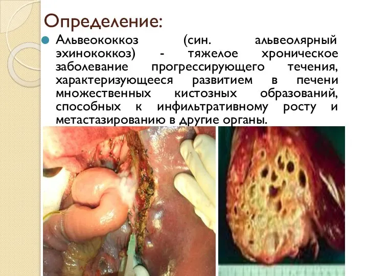 Определение: Альвеококкоз (син. альвеолярный эхинококкоз) - тяжелое хроническое заболевание прогрессирующего течения,