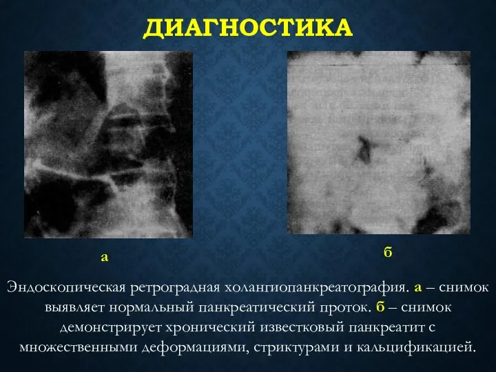 ДИАГНОСТИКА Эндоскопическая ретроградная холангиопанкреатография. а – снимок выявляет нормальный панкреатический проток.