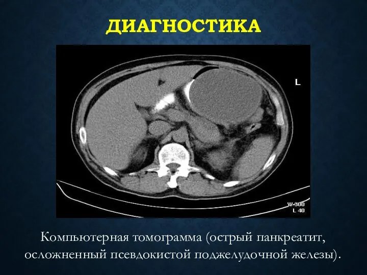 ДИАГНОСТИКА Компьютерная томограмма (острый панкреатит, осложненный псевдокистой поджелудочной железы).