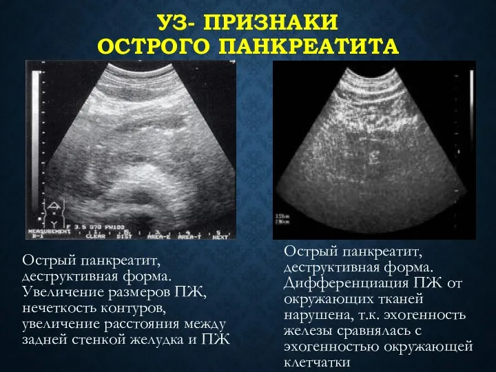 УЗ- ПРИЗНАКИ ОСТРОГО ПАНКРЕАТИТА Острый панкреатит, деструктивная форма. Увеличение размеров ПЖ,