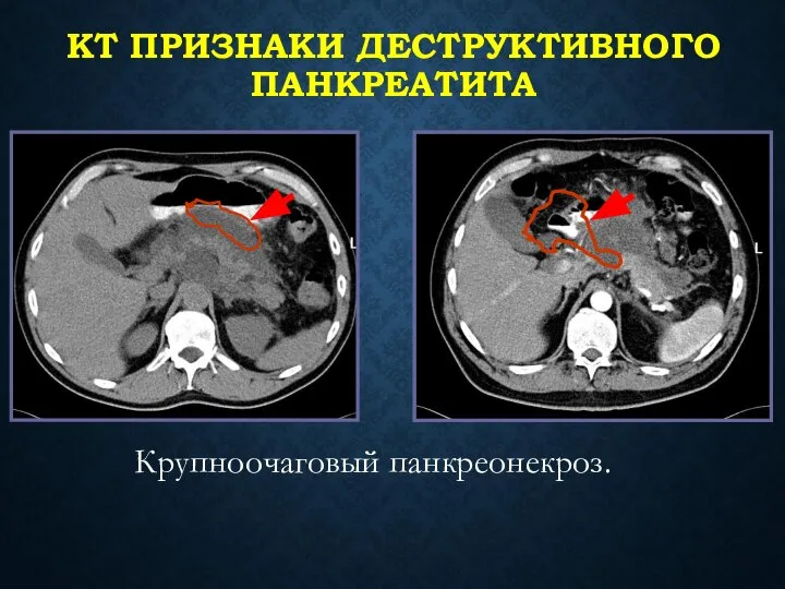 КТ ПРИЗНАКИ ДЕСТРУКТИВНОГО ПАНКРЕАТИТА Крупноочаговый панкреонекроз.