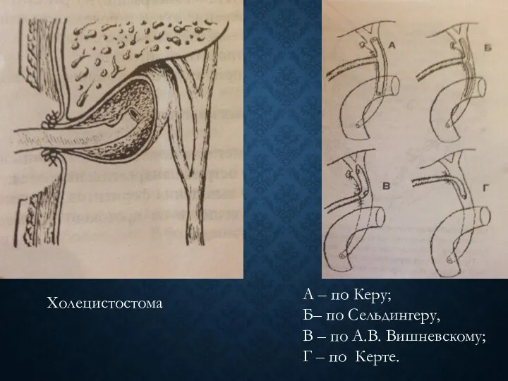 Холецистостома А – по Керу; Б– по Сельдингеру, В – по
