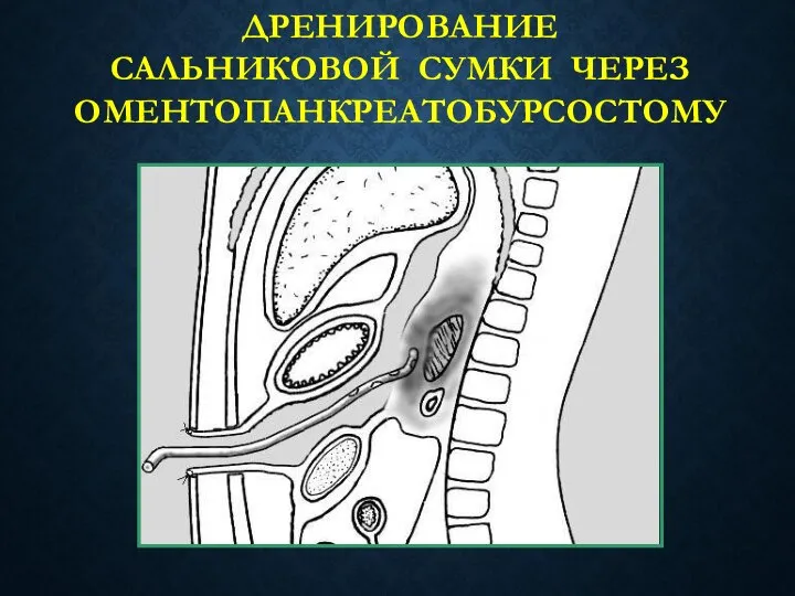 ДРЕНИРОВАНИЕ САЛЬНИКОВОЙ СУМКИ ЧЕРЕЗ ОМЕНТОПАНКРЕАТОБУРСОСТОМУ