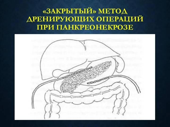 «ЗАКРЫТЫЙ» МЕТОД ДРЕНИРУЮЩИХ ОПЕРАЦИЙ ПРИ ПАНКРЕОНЕКРОЗЕ