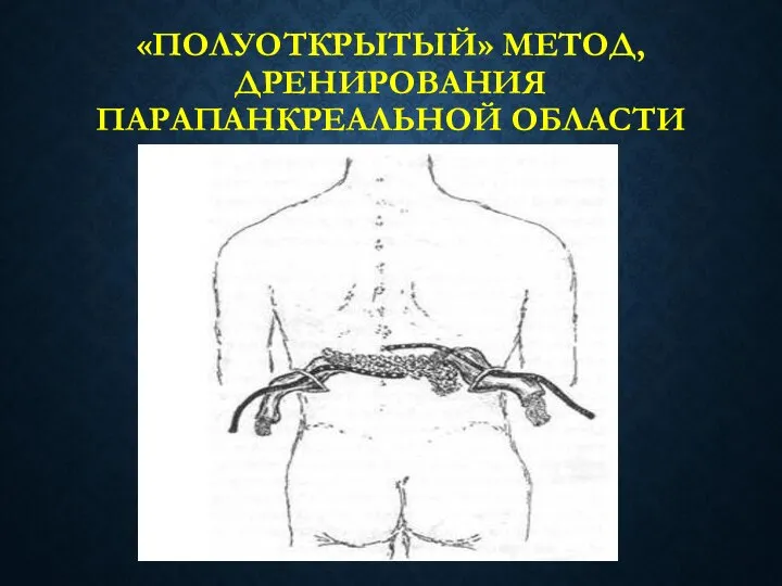 «ПОЛУОТКРЫТЫЙ» МЕТОД, ДРЕНИРОВАНИЯ ПАРАПАНКРЕАЛЬНОЙ ОБЛАСТИ