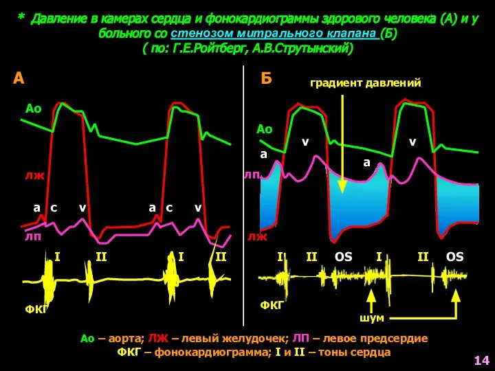 * Давление в камерах сердца и фонокардиограммы здорового человека (А) и