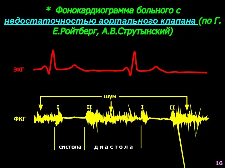 * Фонокардиограмма больного с недостаточностью аортального клапана (по Г.Е.Ройтберг, А.В.Струтынский) ЭКГ