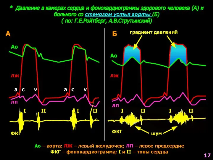 * Давление в камерах сердца и фонокардиограммы здорового человека (А) и