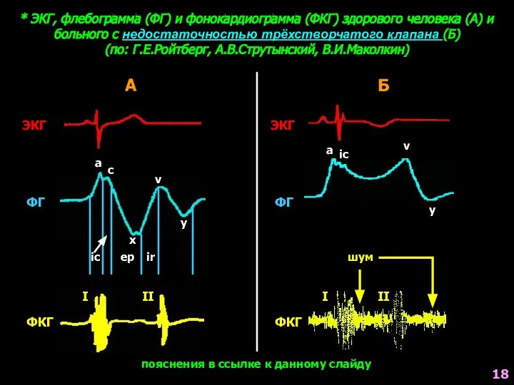 * ЭКГ, флебограмма (ФГ) и фонокардиограмма (ФКГ) здорового человека (А) и