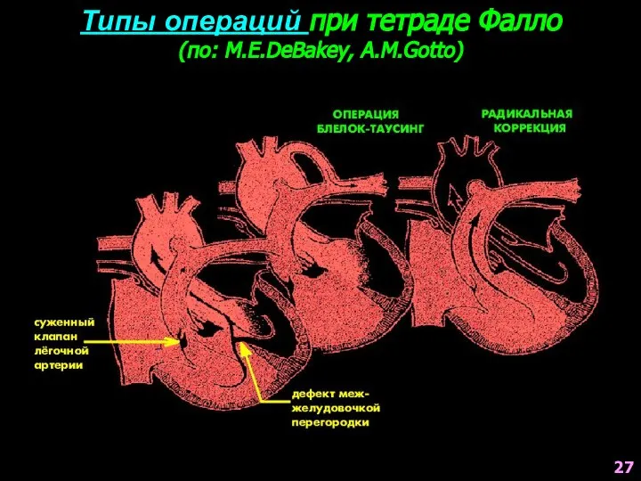 Типы операций при тетраде Фалло (по: M.E.DeBakey, A.M.Gotto) 27