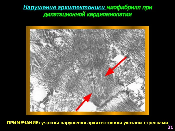 Нарушение архитектоники миофибрилл при дилатационной кардиомиопатии ПРИМЕЧАНИЕ: участки нарушения архитектоники указаны стрелками 31