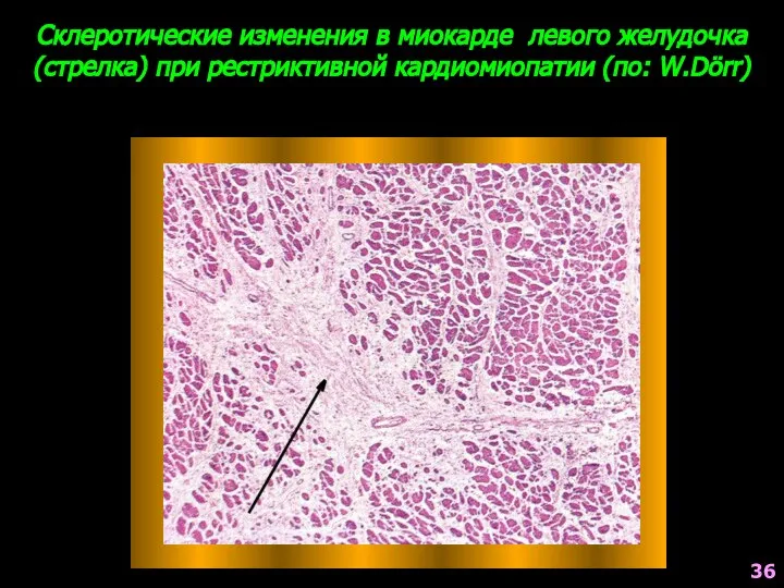 Склеротические изменения в миокарде левого желудочка(стрелка) при рестриктивной кардиомиопатии (по: W.Dörr) 36