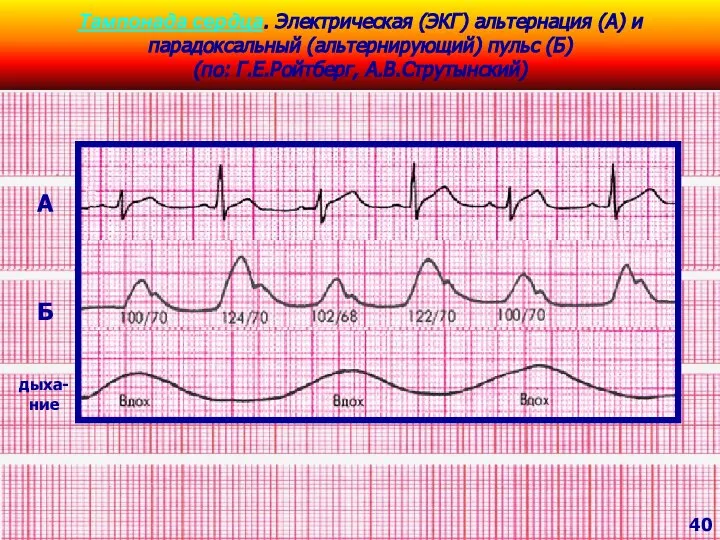 Тампонада сердца. Электрическая (ЭКГ) альтернация (А) и парадоксальный (альтернирующий) пульс (Б)