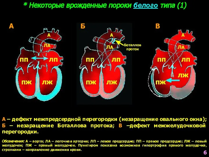 * Некоторые врожденные пороки белого типа (1) А – дефект межпредсердной