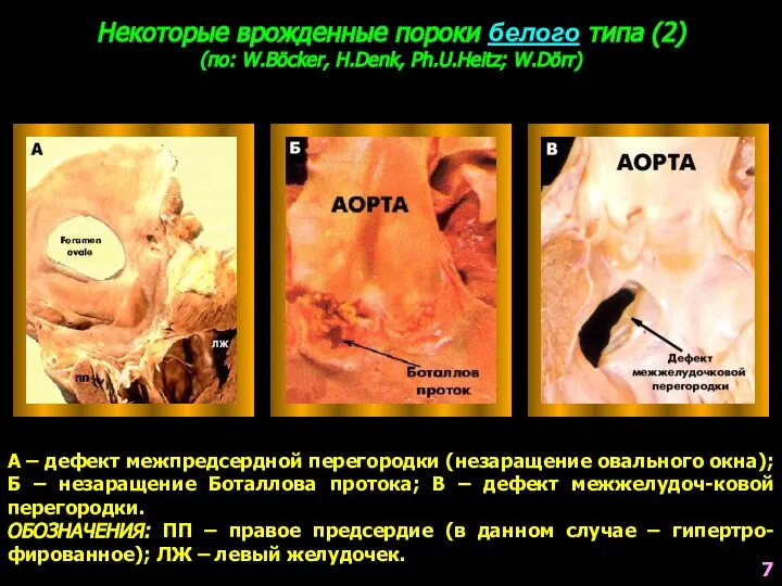 Некоторые врожденные пороки белого типа (2) (по: W.Böcker, H.Denk, Ph.U.Heitz; W.Dörr)