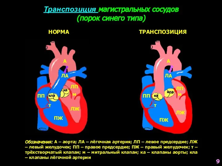 Транспозиция магистральных сосудов (порок синего типа) НОРМА А ЛА ПП ПЖ