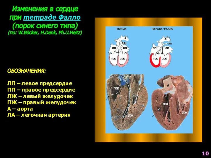 Изменения в сердце при тетраде Фалло (порок синего типа) (по: W.Böcker,