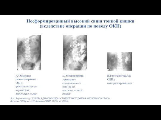 Несформированный высокий свищ тонкой кишки (вследствие операции по поводу ОКН) А.Обзорная