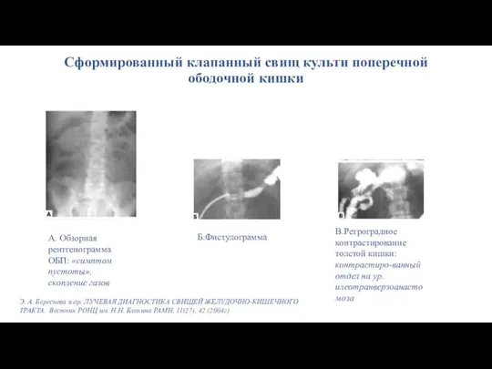 Сформированный клапанный свищ культи поперечной ободочной кишки Э. А. Береснева и