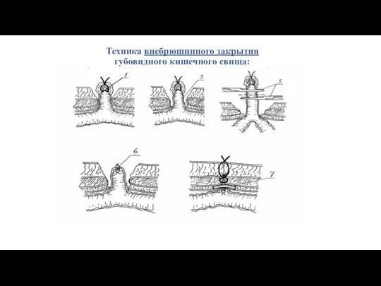 Техника внебрюшинного закрытия губовидного кишечного свища: