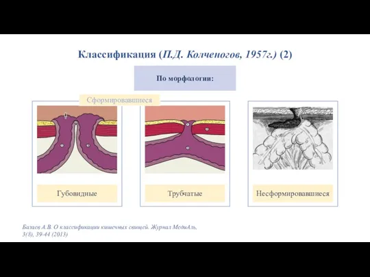 Классификация (П.Д. Колченогов, 1957г.) (2) Базаев А.В. О классификации кишечных свищей.