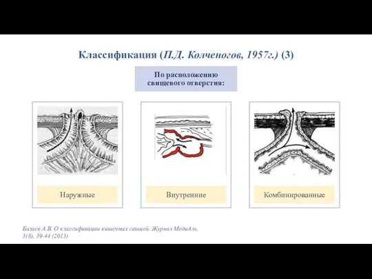 Классификация (П.Д. Колченогов, 1957г.) (3) Базаев А.В. О классификации кишечных свищей.