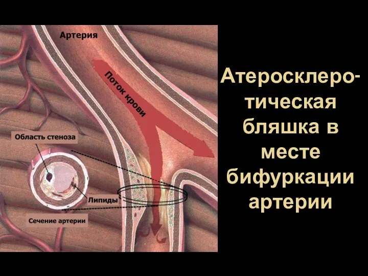 Атеросклеро-тическая бляшка в месте бифуркации артерии