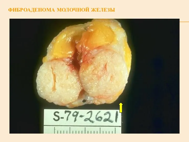 ФИБРОАДЕНОМА МОЛОЧНОЙ ЖЕЛЕЗЫ