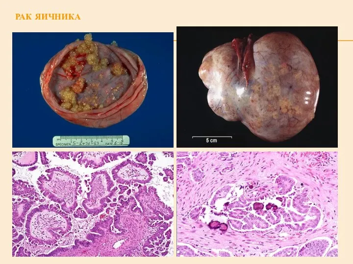 РАК ЯИЧНИКА