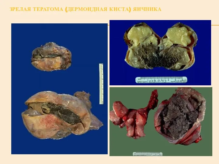 ЗРЕЛАЯ ТЕРАТОМА (ДЕРМОИДНАЯ КИСТА) ЯИЧНИКА