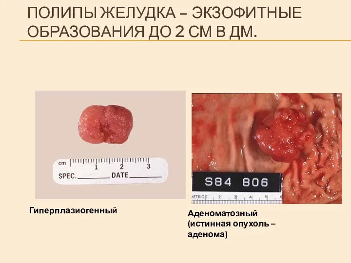 ПОЛИПЫ ЖЕЛУДКА – ЭКЗОФИТНЫЕ ОБРАЗОВАНИЯ ДО 2 СМ В ДМ. Гиперплазиогенный Аденоматозный (истинная опухоль – аденома)