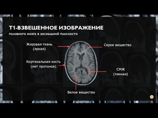 Т1-ВЗВЕШЕННОЕ ИЗОБРАЖЕНИЕ головного мозга в аксиальной плоскости Жировая ткань (яркая) СМЖ