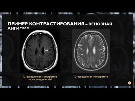 ПРИМЕР КОНТРАСТИРОВАНИЯ – ВЕНОЗНАЯ АНГИОМА Т2-взвешенная томограмма Т1-взвешенная томограмма после введения Gd