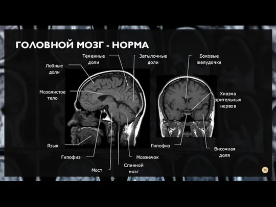 ГОЛОВНОЙ МОЗГ - НОРМА Язык Спинной мозг Мозжечок Мост Гипофиз Лобные