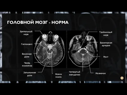 ГОЛОВНОЙ МОЗГ - НОРМА Затылочная доля Червь мозжечка Ножки мозга Гиппокамп