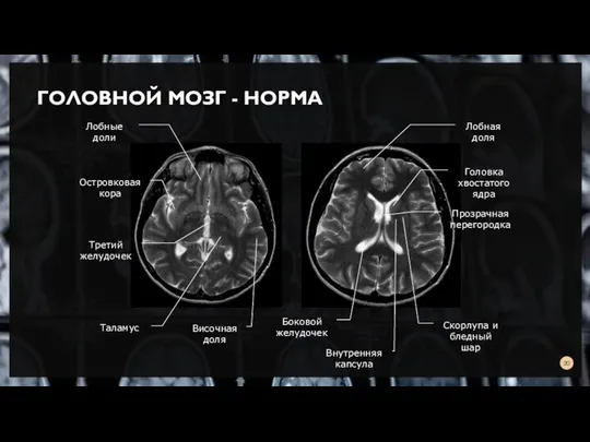 ГОЛОВНОЙ МОЗГ - НОРМА Лобные доли Третий желудочек Островковая кора Таламус