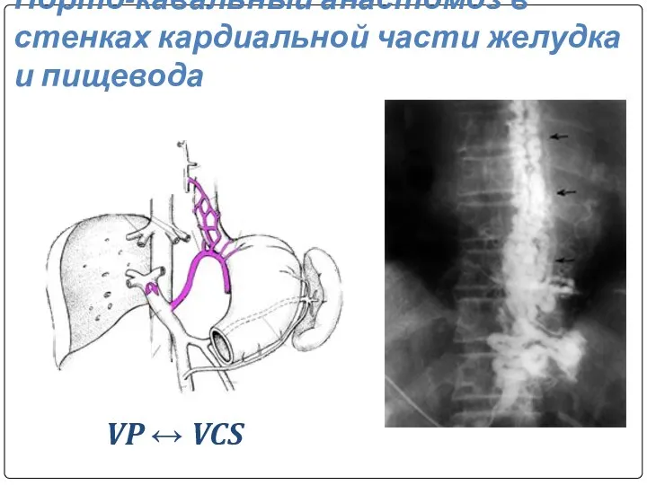 Порто-кавальный анастомоз в стенках кардиальной части желудка и пищевода VP ↔ VCS