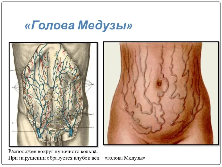 «Голова Медузы» Расположен вокруг пупочного кольца. При нарушении образуется клубок вен – «голова Медузы»