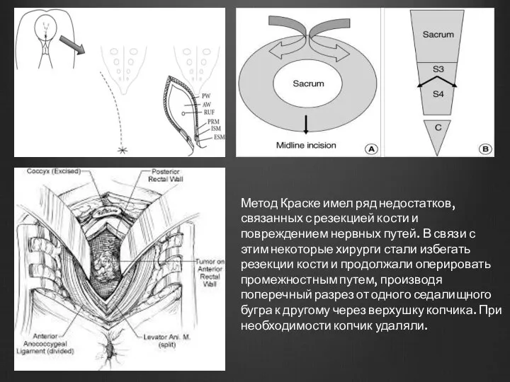 Метод Краске имел ряд недостатков, связанных с резекцией кости и повреждением