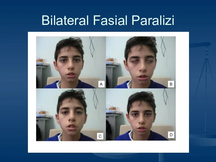 Bilateral Fasial Paralizi