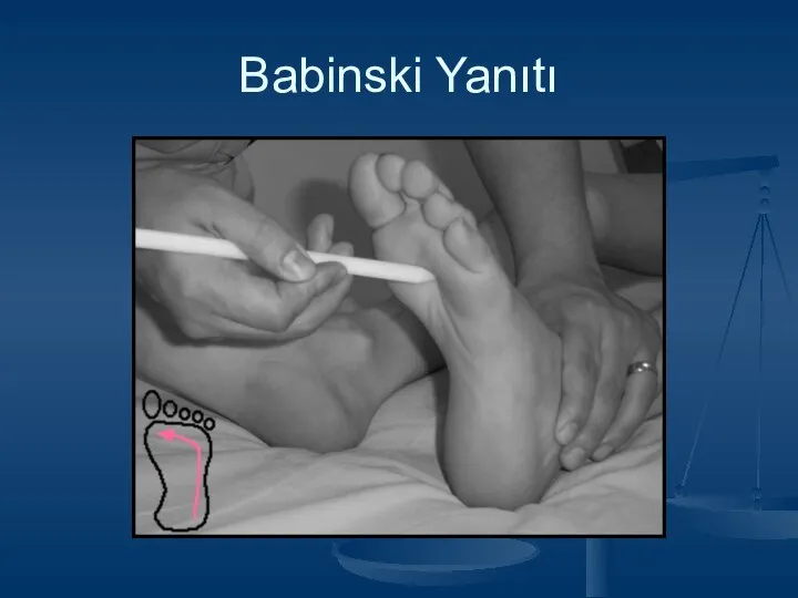 Babinski Yanıtı