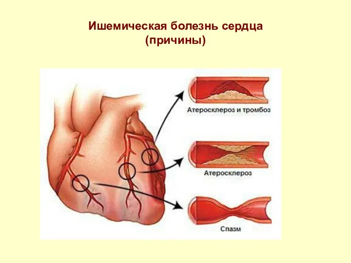 Ишемическая болезнь сердца (причины)